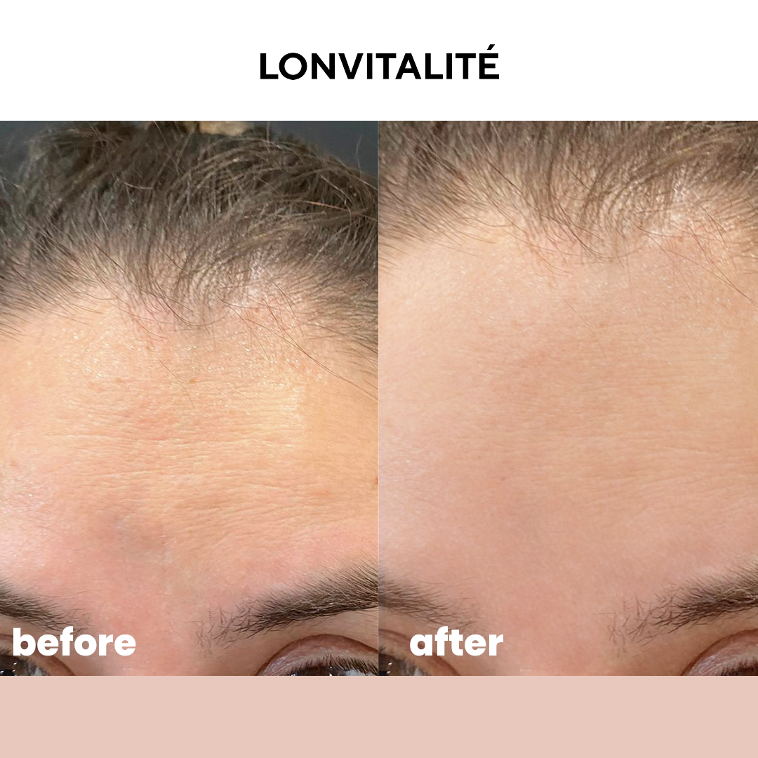 Derma Roller with Titanium Needle For Hair Growth | (0.5mm)